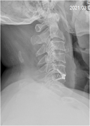 1623148195607510.png 术后 图片2.png